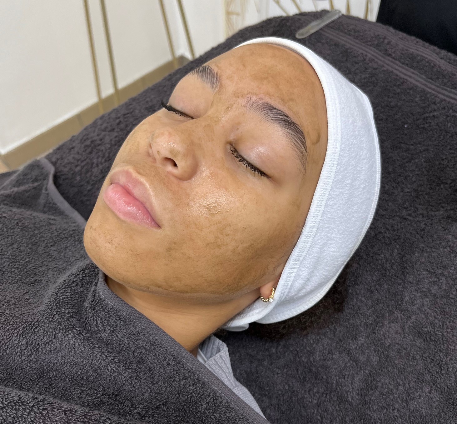 bio microneedling